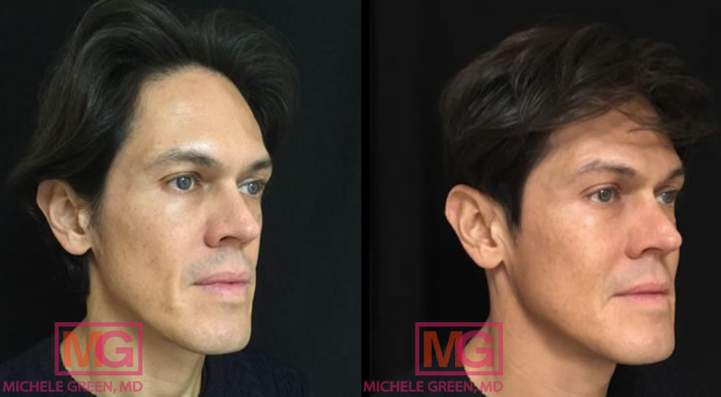 Botox for Neck Lines